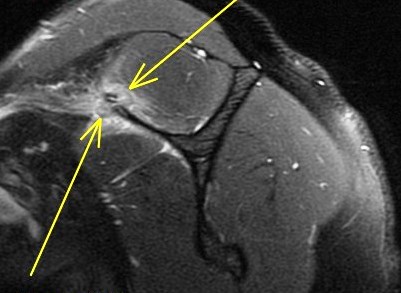 Figure 6 for case scapular fracture and supraspinatus and subscapularis muscle strain ( RID1860 ) ( RID1870 )